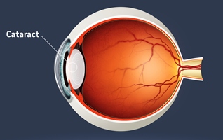 Cataract_diagram_small.jpg